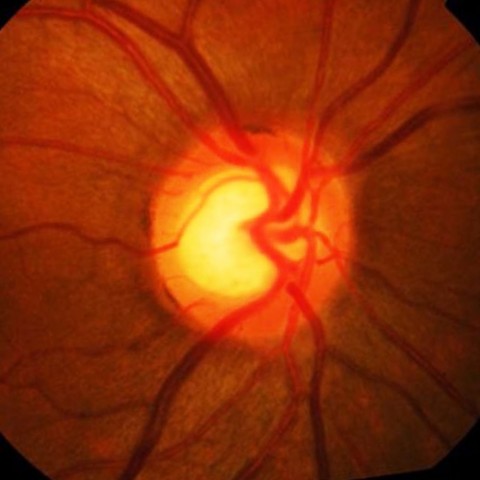 Glaucoma Nervo ottico